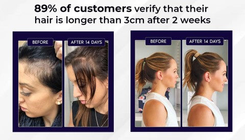 🌿LAST DAY PROMOTION - 70% OFF🌿 HZA™ Natural Hair Regrowth Spray