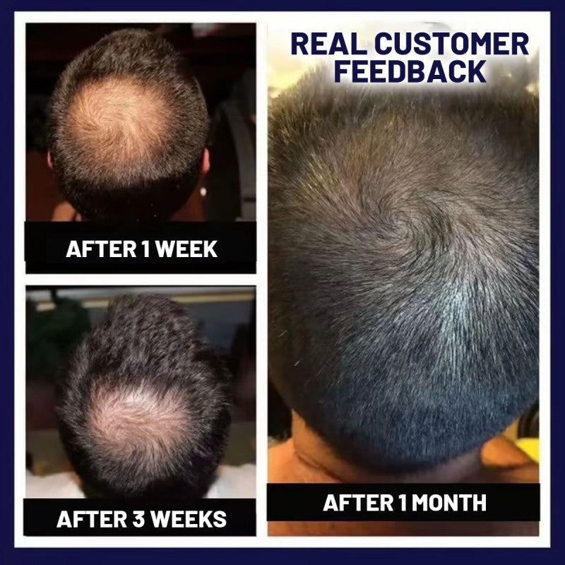 🌿LAST DAY PROMOTION - 70% OFF🌿 HZA™ Natural Hair Regrowth Spray